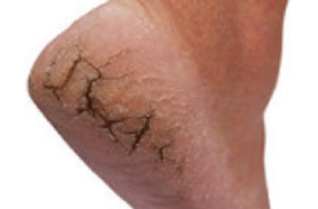 Foot Cracks